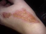 Термичесский ожог на руке. О горячий нож фото 1