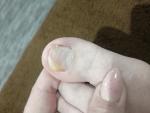 Проблема с ногтем, пустота под ним и поменялся цвет ногтя фото 1