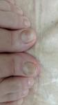 Пятна на ногтях больших пальцев ног фото 1