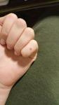 Что означает маленькая красная точка на пальце руки? фото 3