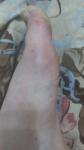Болит палец левой ноги фото 2