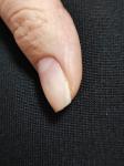 Грибок на ногтях или прибит как определить? фото 2