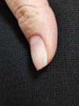 Грибок на ногтях или прибит как определить? фото 1