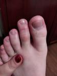 Шелушение и покраснение пальцев ног фото 3