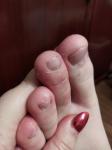 Шелушение и покраснение пальцев ног фото 2