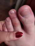 Шелушение и покраснение пальцев ног фото 1