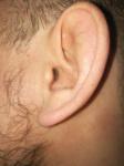 Отëк ушного отверстия, вследствие простудного заболевания фото 2