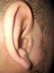 Отëк ушного отверстия, вследствие простудного заболевания фото 1