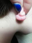 Келоидный рубец или фиброма на мочке уха после прокола фото 5