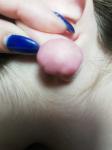 Келоидный рубец или фиброма на мочке уха после прокола фото 4