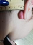 Келоидный рубец или фиброма на мочке уха после прокола фото 2