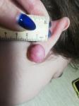 Келоидный рубец или фиброма на мочке уха после прокола фото 1