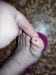 Чёрная точка на большом пальце ноги фото 1
