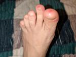 Красно-синин пятна на пальцах ног фото 1