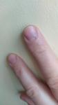 Темное пятно на ногте руки фото 1