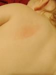 Красное пятно на спине у ребёнка, как утюгом прижгли фото 3
