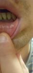 Бородавка на внутренней стороне губы фото 5