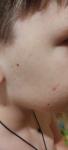 Сыпь на щеках и предплечье фото 1