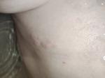 Красная уплотнённая сыпь в районе ребер, чуть ниже груди фото 1