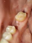 Боль в соседнем зубе после имплантации и удаление зуба мудрости фото 1