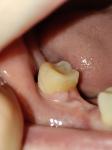 Боль в соседнем зубе после имплантации и удаление зуба мудрости фото 2
