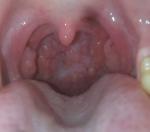 Пупырышки на задней части горла, першение в горле и насморк фото 1
