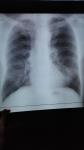 Рентген лёгких. Это воспаление? фото 1