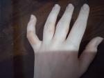 Тёмные пятна на пальцах рук фото 2