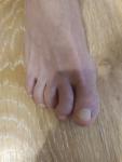 Воспаление второго пальца на ноге фото 1