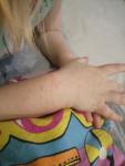 Красная сыпь на руках у ребенка, 2.5 года фото 1