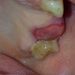 Осложнение после удаления зуба фото 1