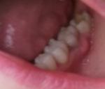У больного зуба припухла десна фото 1
