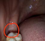 Пятно на десне после удаления зуба фото 1