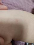 Сухие пятнышки на теле у ребенка 1.2 года фото 3
