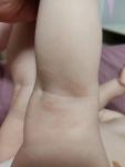Сухие пятнышки на теле у ребенка 1.2 года фото 2