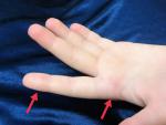 Сильная боль в указательном пальце левой руки фото 1