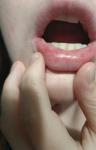 Что за красные пятна внутри губы? фото 1