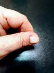 Деформация ногтевой пластины фото 1
