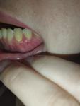 Болячки после лечения зуба фото 3