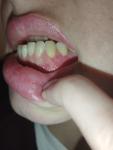 Болячки после лечения зуба фото 2