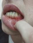 Болячки после лечения зуба фото 1