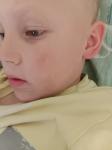 Светло-коричневое пятно на лице у ребенка фото 4