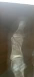 Косой перелом проксимальной фаланги большого пальца ноги с внутрисуставным переломом фото 2
