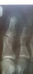 Косой перелом проксимальной фаланги большого пальца ноги с внутрисуставным переломом фото 1