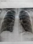 Расшифровка рентгена грудной клетки фото 1