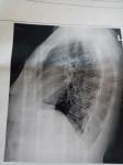 Расшифровка рентгена грудной клетки фото 2