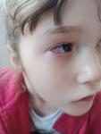 Капиллярное пятно на глазном яблоке ребенка фото 1