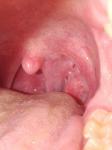 Sore Throat Swollen Tonsil фото 1