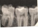 Зуб после лечения глубоко кариеса фото 1