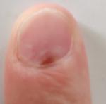 Коричневое пятно на ногте, не болит, не выпирает фото 2
